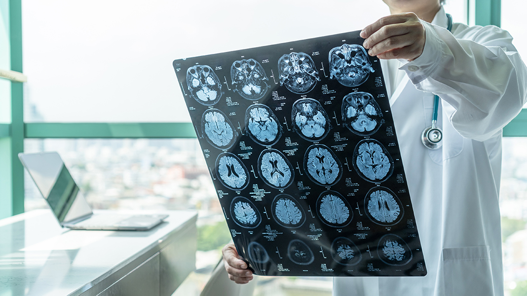 neurolog trzyma w dłoni prześwietlenie mózgu po udarze